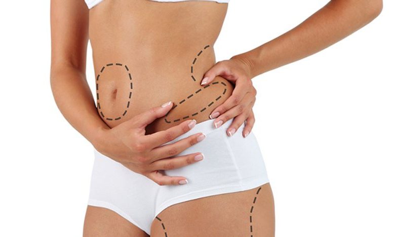 liposuction