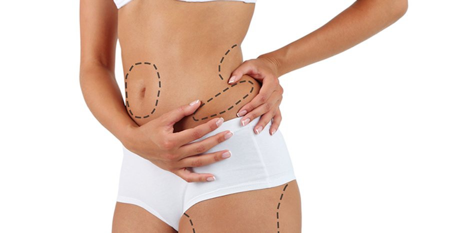 liposuction