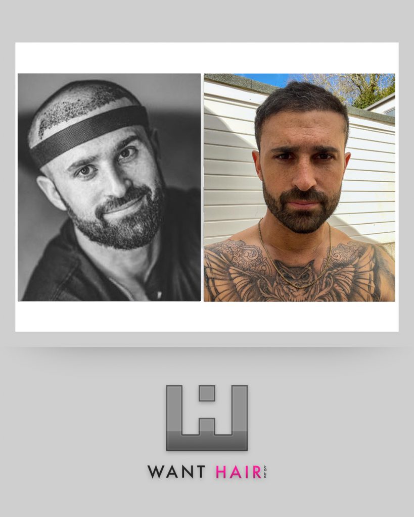 Hair transplant uk