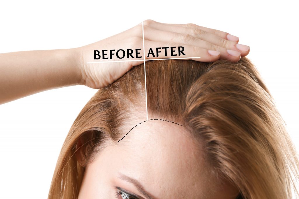 Hairline lowering- Hair Treatments for Women’s Hairline Reduction