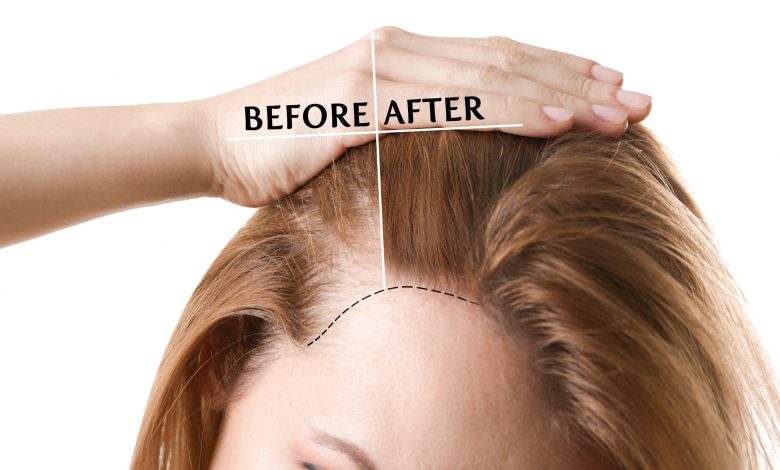 Hairline lowering- Hair Treatments for Women’s Hairline Reduction