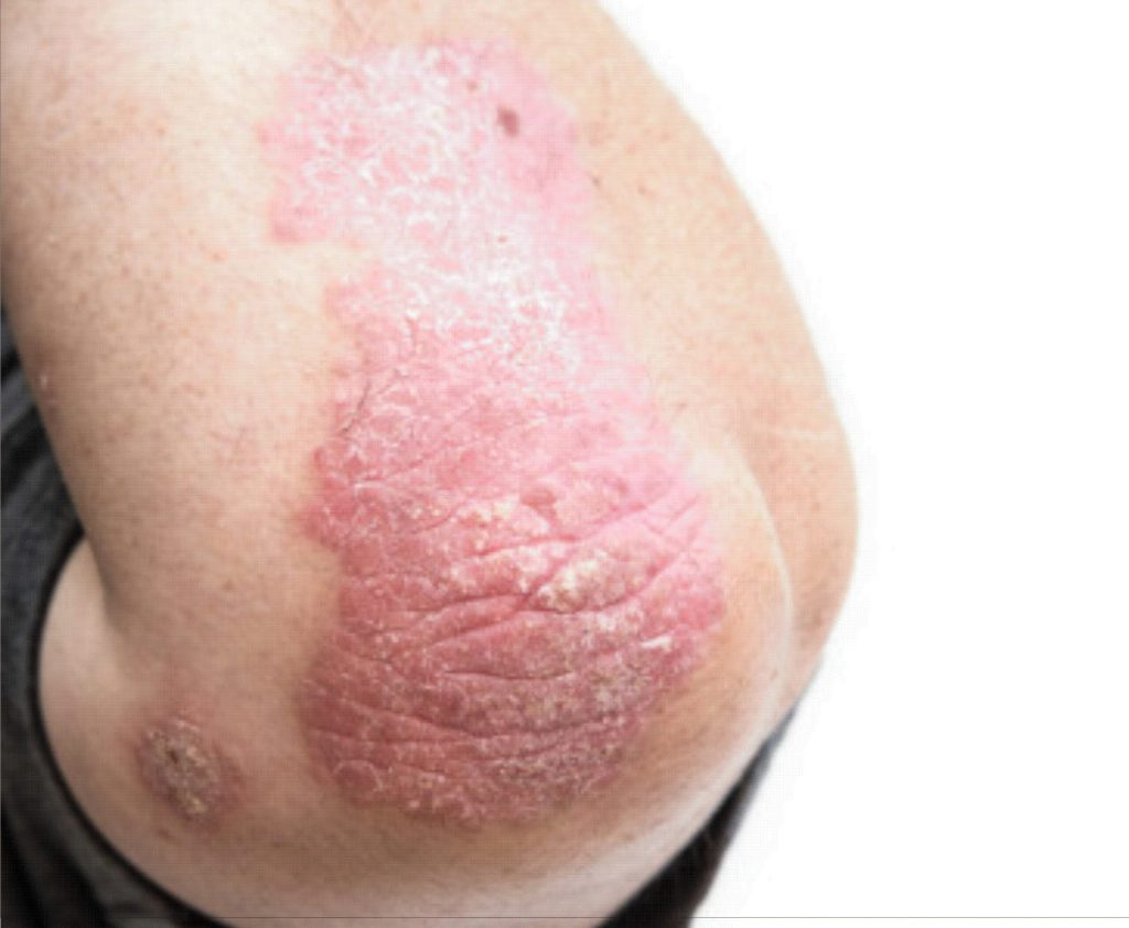 psoriasis