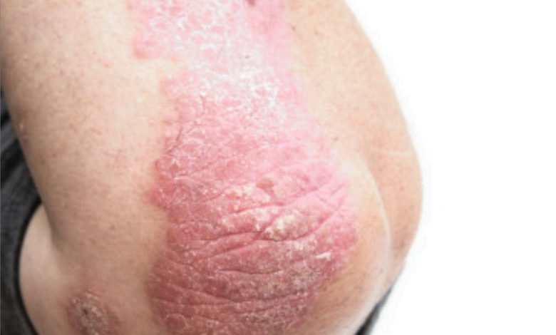 psoriasis