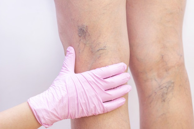 How Does Spider Vein Treatment Work?