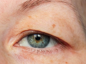 How is droopy eyelid treated?