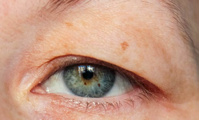 How is droopy eyelid treated?