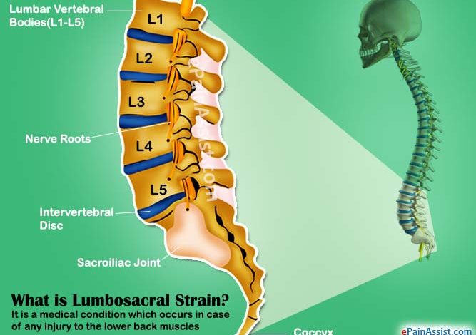 What-are-the-long-term-side-effects-of-a-Lumbosacral-Strain