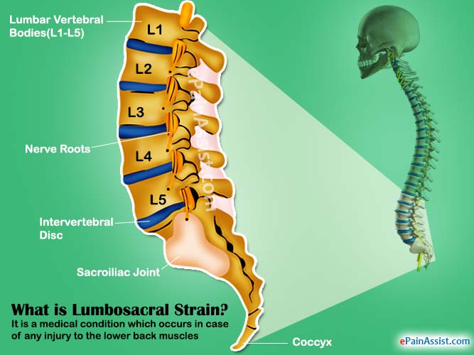 What-are-the-long-term-side-effects-of-a-Lumbosacral-Strain