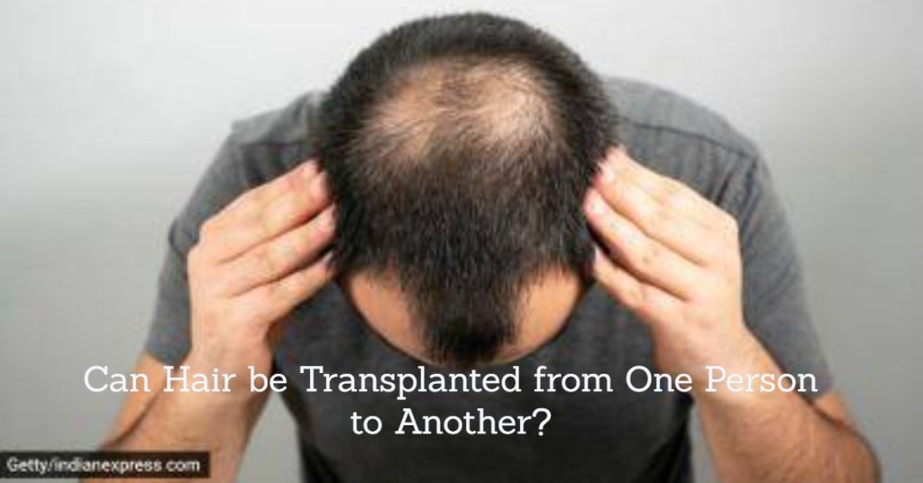 hair transplant