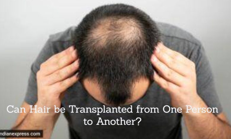 hair transplant