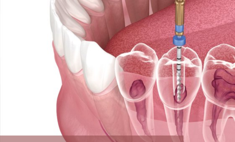 8 Root Canal Treatment Myths Busted