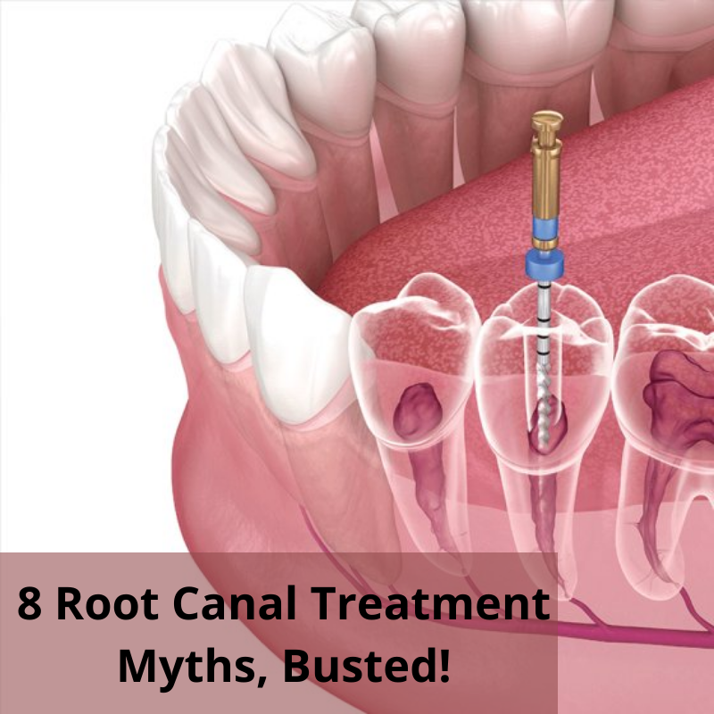 8 Root Canal Treatment Myths Busted