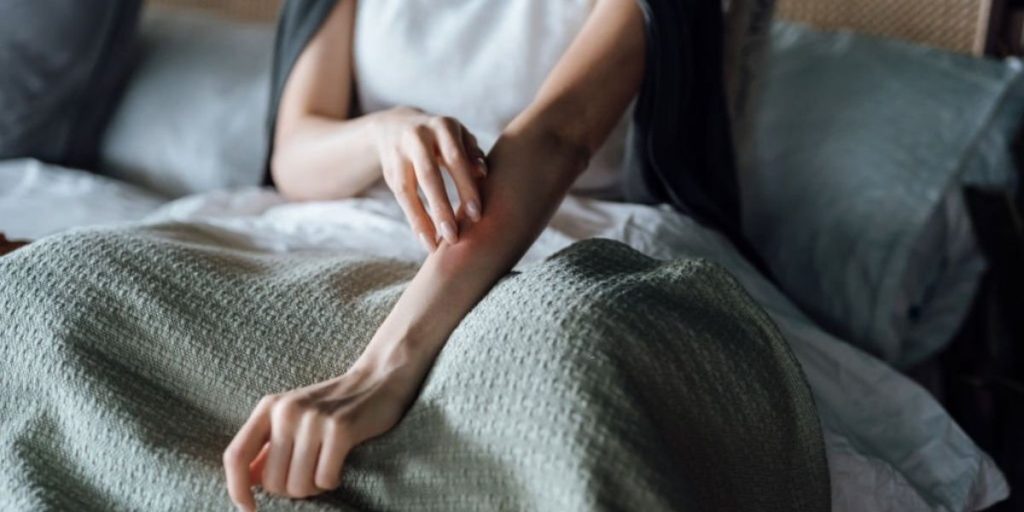 eczema atopic dermatitis